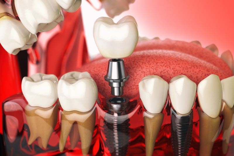 Reclaim Your Confidence with Dental Implants - Dr. Aburas Dental