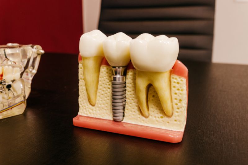 Transform Your Oral Health with Dental Implants - Dr. Aburas Dental
