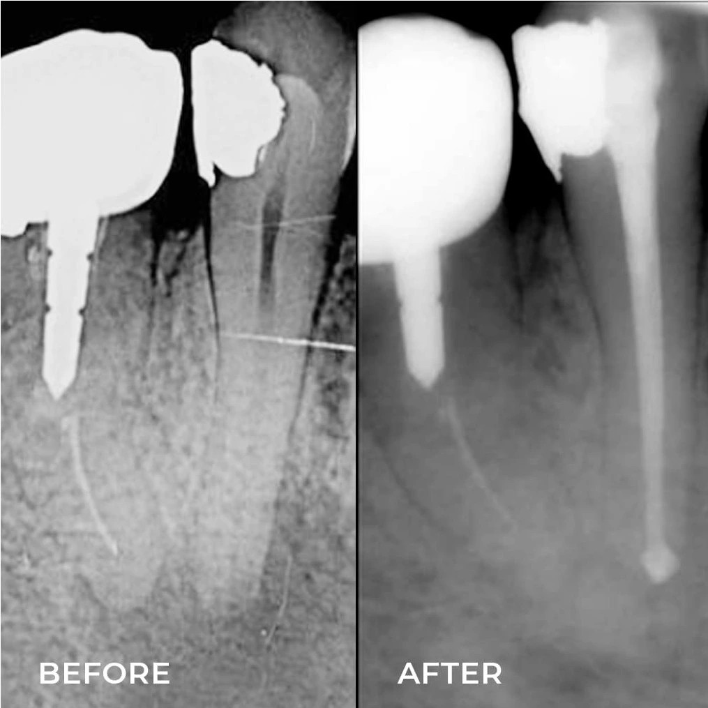 Before After Root Canal Treatment Aburas Dental Centre Before After Root Canal Treatment Aburas Dental Centre