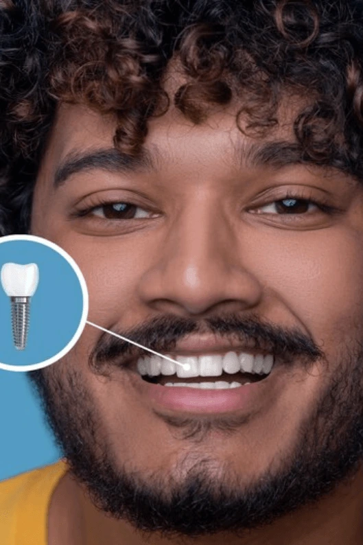 Dental Implant