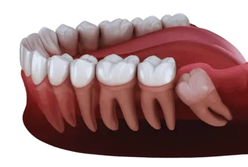 How wisdom tooth is oriented in mouth which leads to pain 